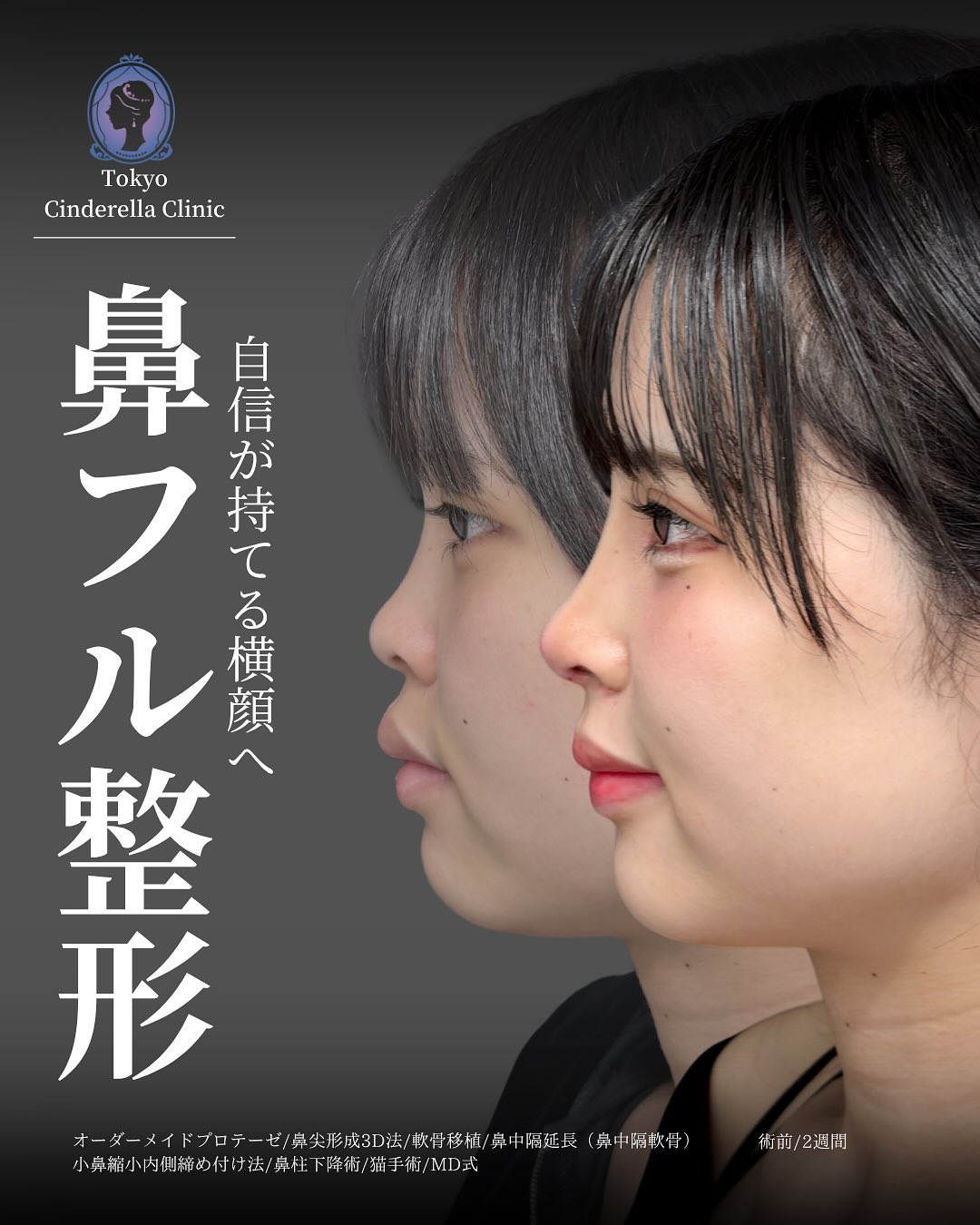 新宿院で行った鼻尖形成3D法と軟骨移植と鼻中隔延長と小鼻縮小内側締め付け法と鼻柱下降術と猫手術の鼻フル整形を行い口元の突出感が改善された2週間後の症例写真