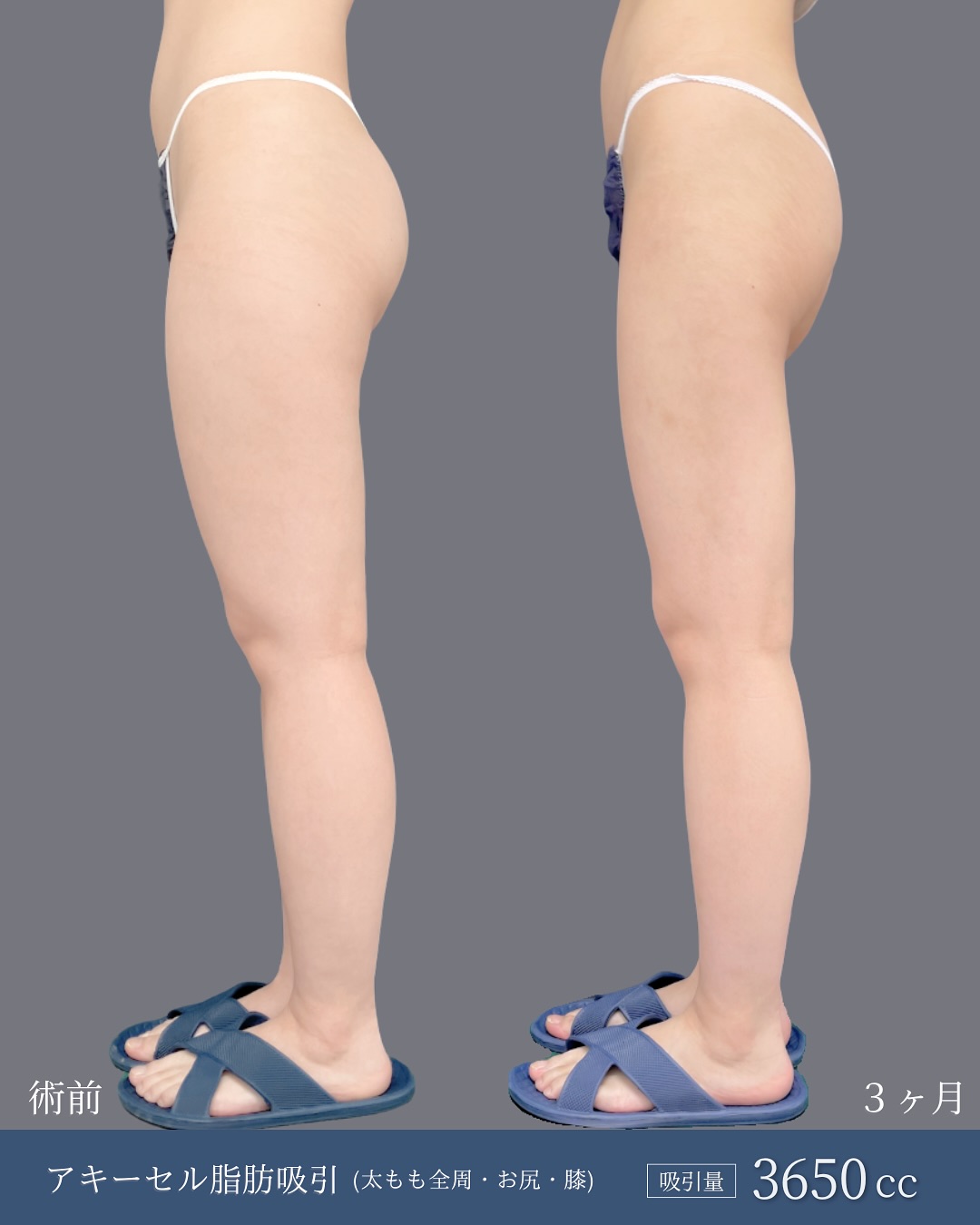 新宿院で行った太ももとお尻と膝のアキーセル脂肪吸引の名医の吉原伯医師の3ヵ月後の症例写真