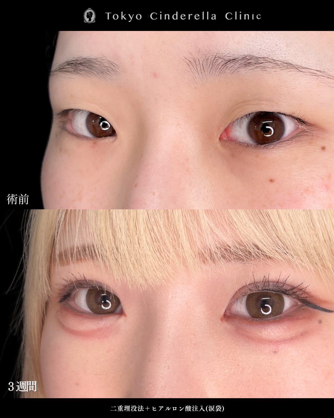 二重埋没法と涙袋ヒアルで可愛い末広二重になった３週間比較症例