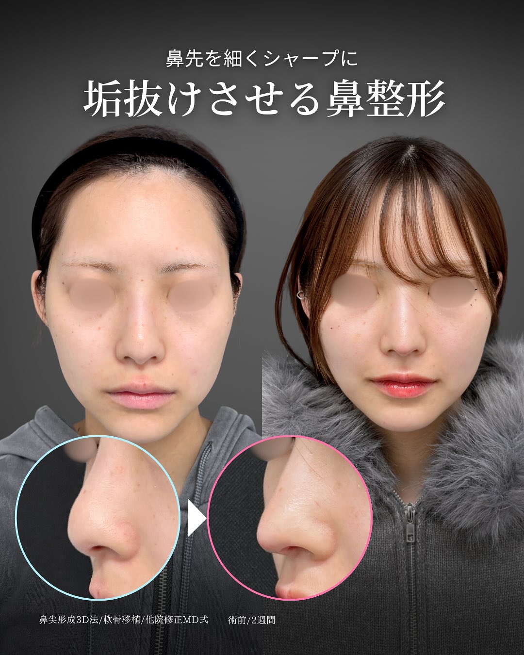 新宿院で行った鼻尖形成3D法と軟骨移植の2週間後の症例写真