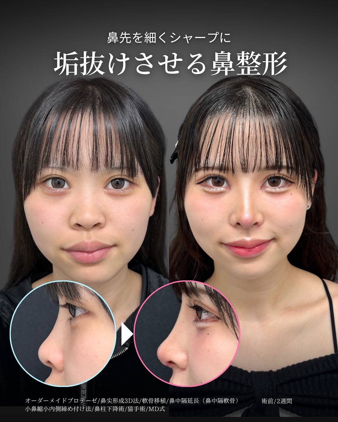 新宿院で行った鼻尖形成3D法と軟骨移植と鼻中隔延長と小鼻縮小内側締め付け法と鼻柱下降術と猫手術の鼻フル整形を行った2週間後の口元の突出感が改善された症例写真