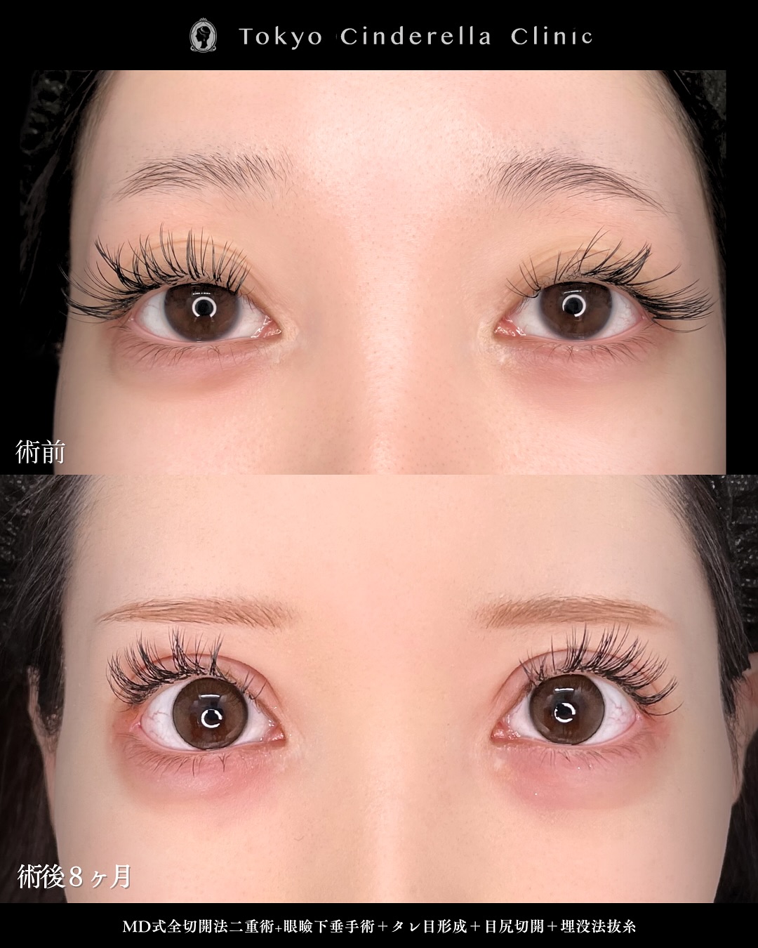 新宿院で行った二重整形で有名な吉原伯医師のMD式の全切開法二重術と眼瞼下垂手術と目尻切開とタレ目形成(結膜切開)と埋没法抜糸を行った8ヵ月後の症例写真