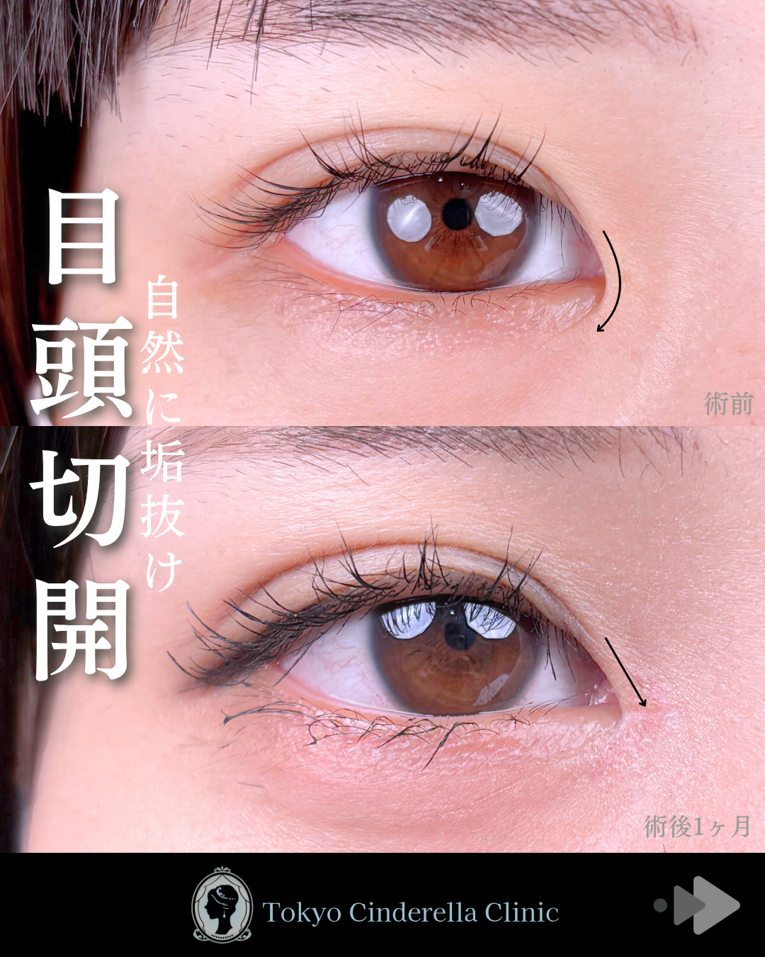 池袋院で行ったMD式目頭切開整形で有名な名医の石井達也の症例写真