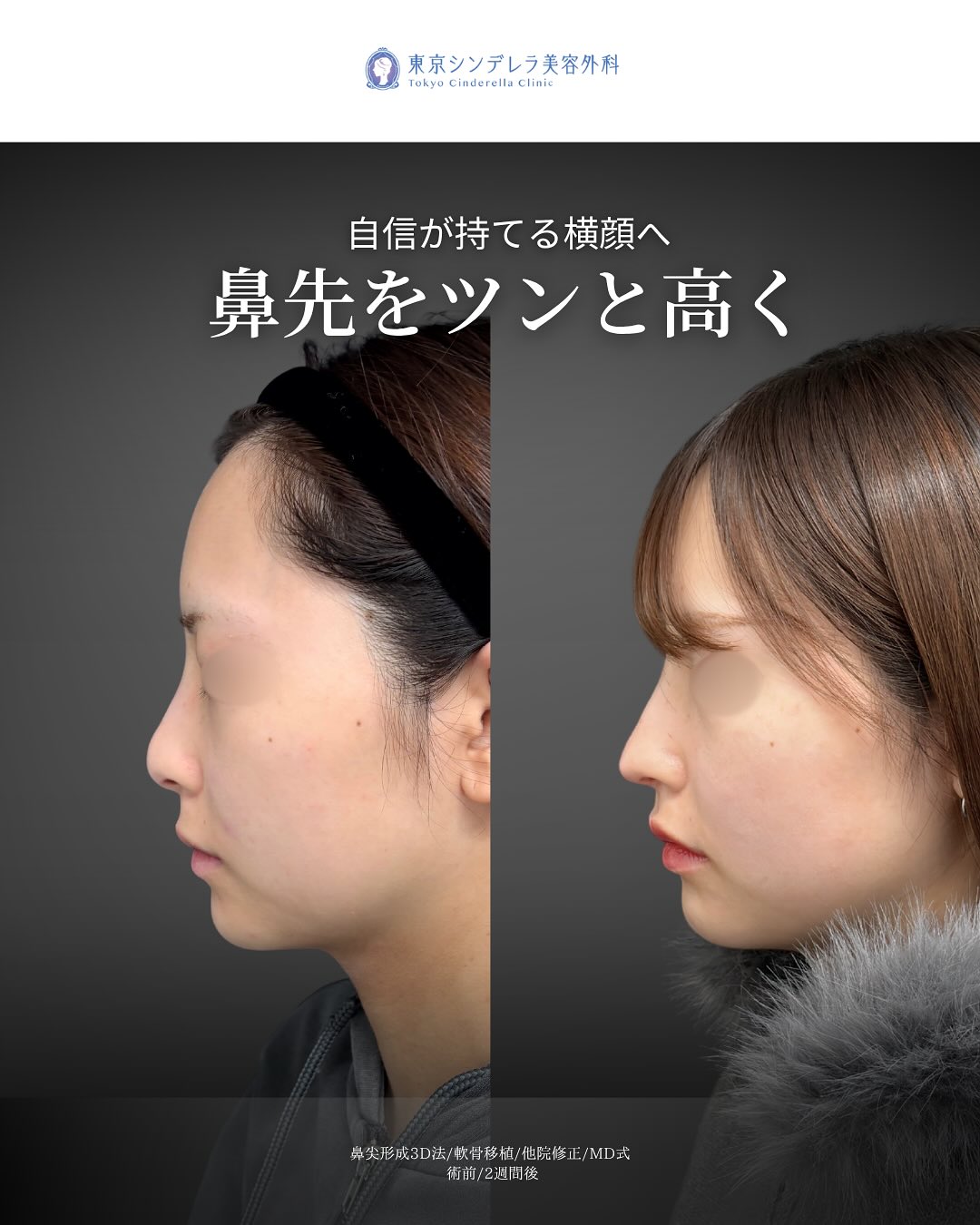 新宿院で行った鼻尖形成3D法と軟骨移植の2週間後の症例写真