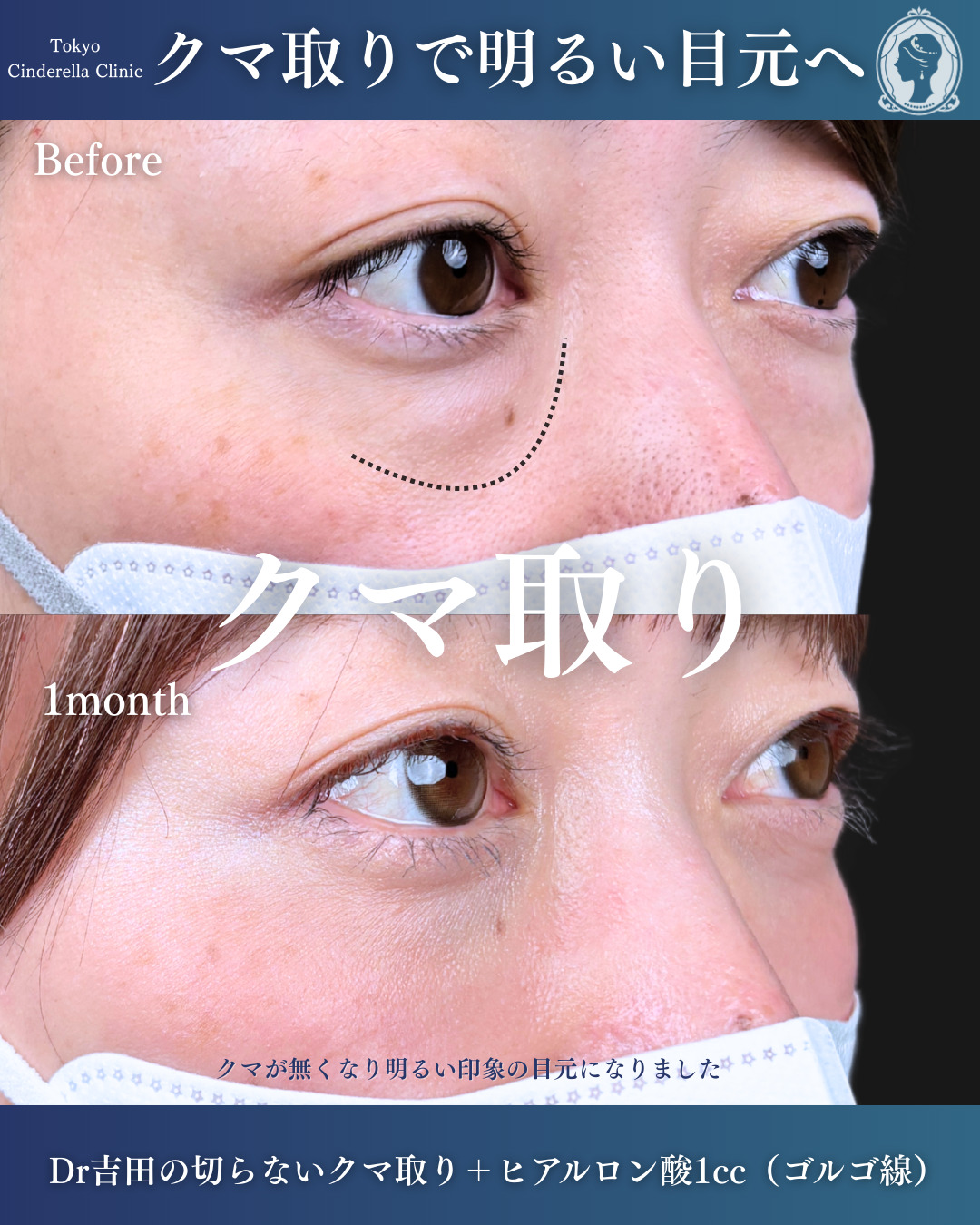 新宿院で行ったクマ治療の名医の吉田利之医師の症例写真