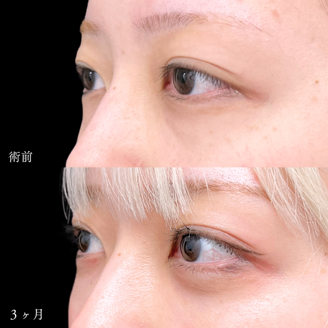 切らないクマ取りと目の下のヒアルロン酸注入で疲れ顔改善し若々しく変化した20代の症例