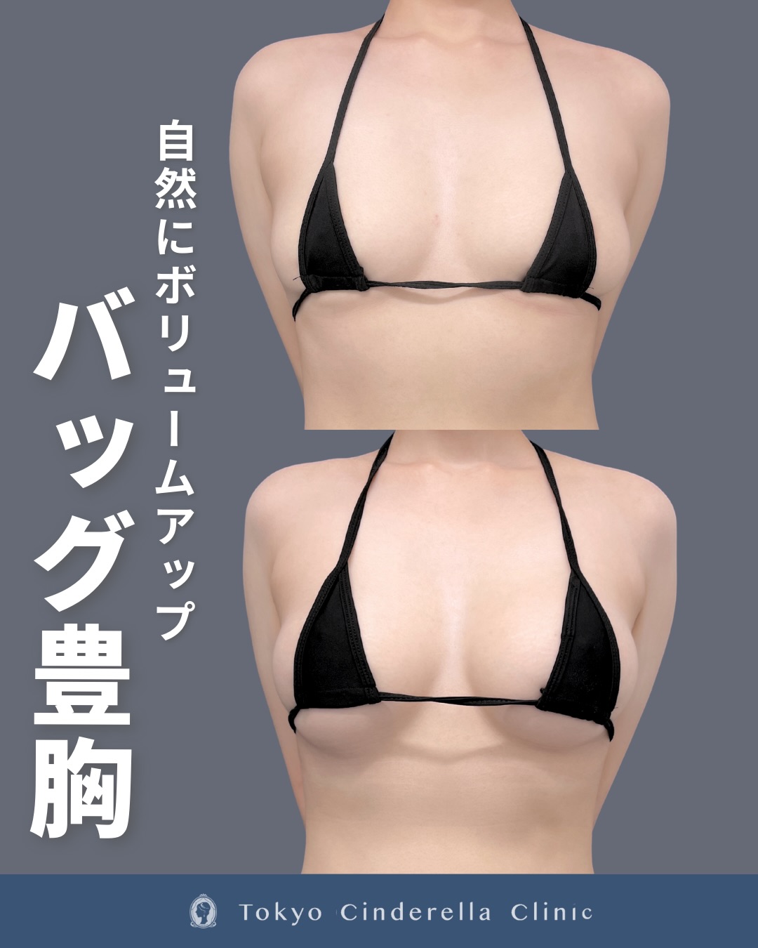 新宿院で行ったシリコンバック豊胸の1ヵ月後の症例写真