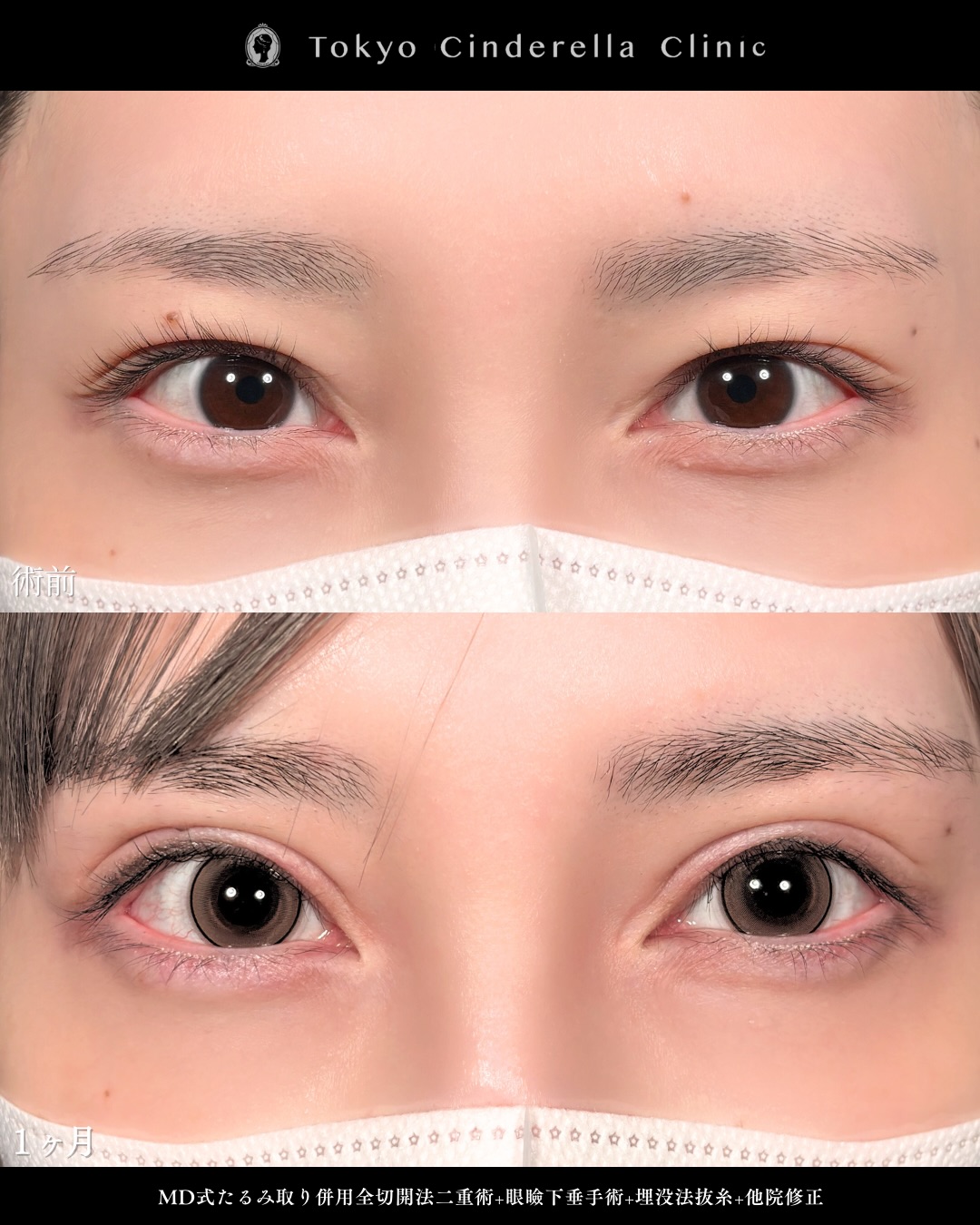 新宿院で行った二重整形で有名な吉原伯医師のMD式のたるみ取り併用全切開法二重術と眼瞼下垂手術と他院修正の1ヵ月までのダウンタイム症例写真