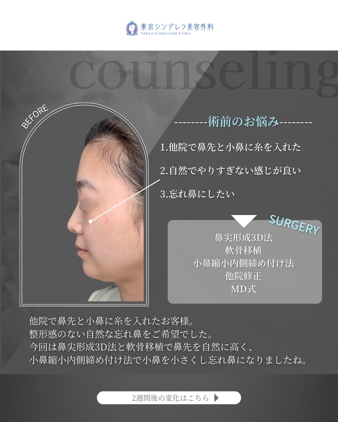 新宿院で行ったMD式の鼻尖形成3D法と軟骨移植と小鼻縮小内側締め付け法と他院修正の2週間後の症例写真