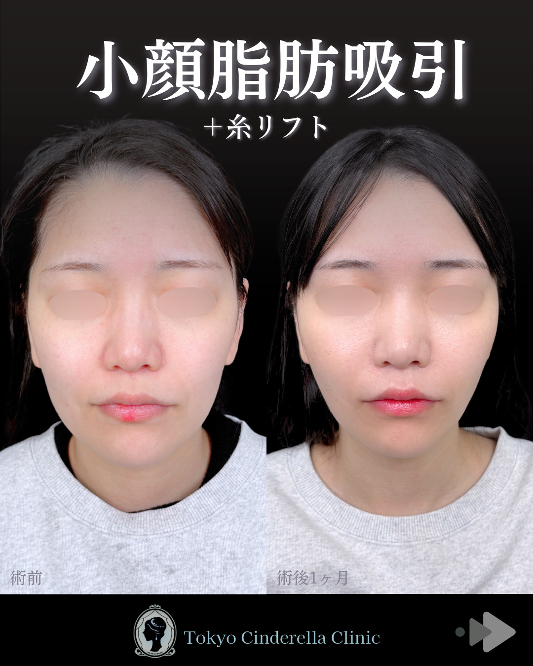 池袋院で行った小顔脂肪吸引(頬・あご下・エラ下・ジョールファット) とクイックリフト12本整形で有名な名医の石井達也の症例写真
