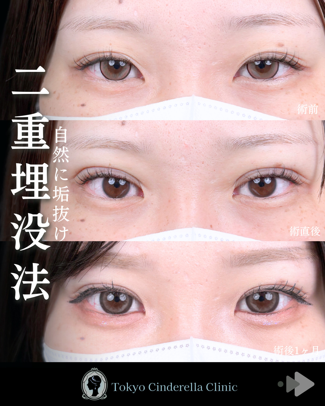 EYEeyelid surgeryセレクト美容塾・眼瞼　美容外科形成外科 二重ラインくっきり変化！ 」に関する美容整形の症例写真の詳細 | 新宿