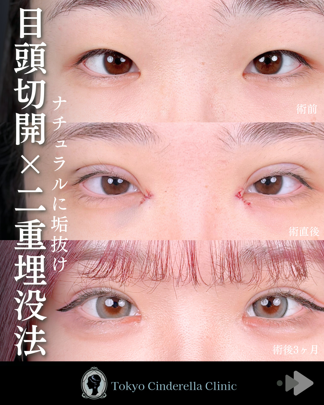 池袋院で行ったMD式目頭切開と韓国式自然癒着法6点整形で有名な名医の石井達也の症例写真