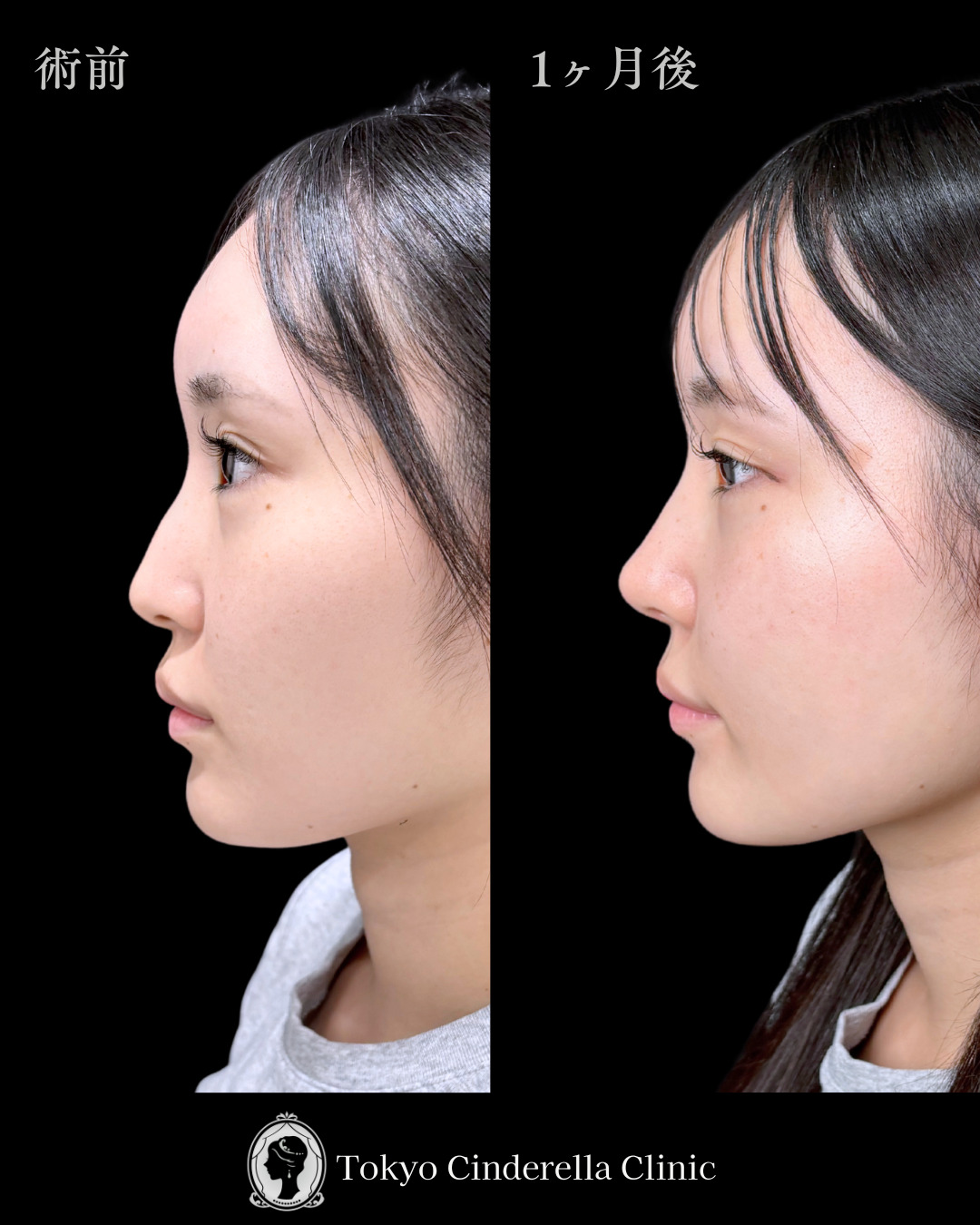 池袋院で行ったMD式の鼻尖形成3D法と軟骨移植とわし鼻削りとヒアルロン酸（貴族）整形の名医の症例写真