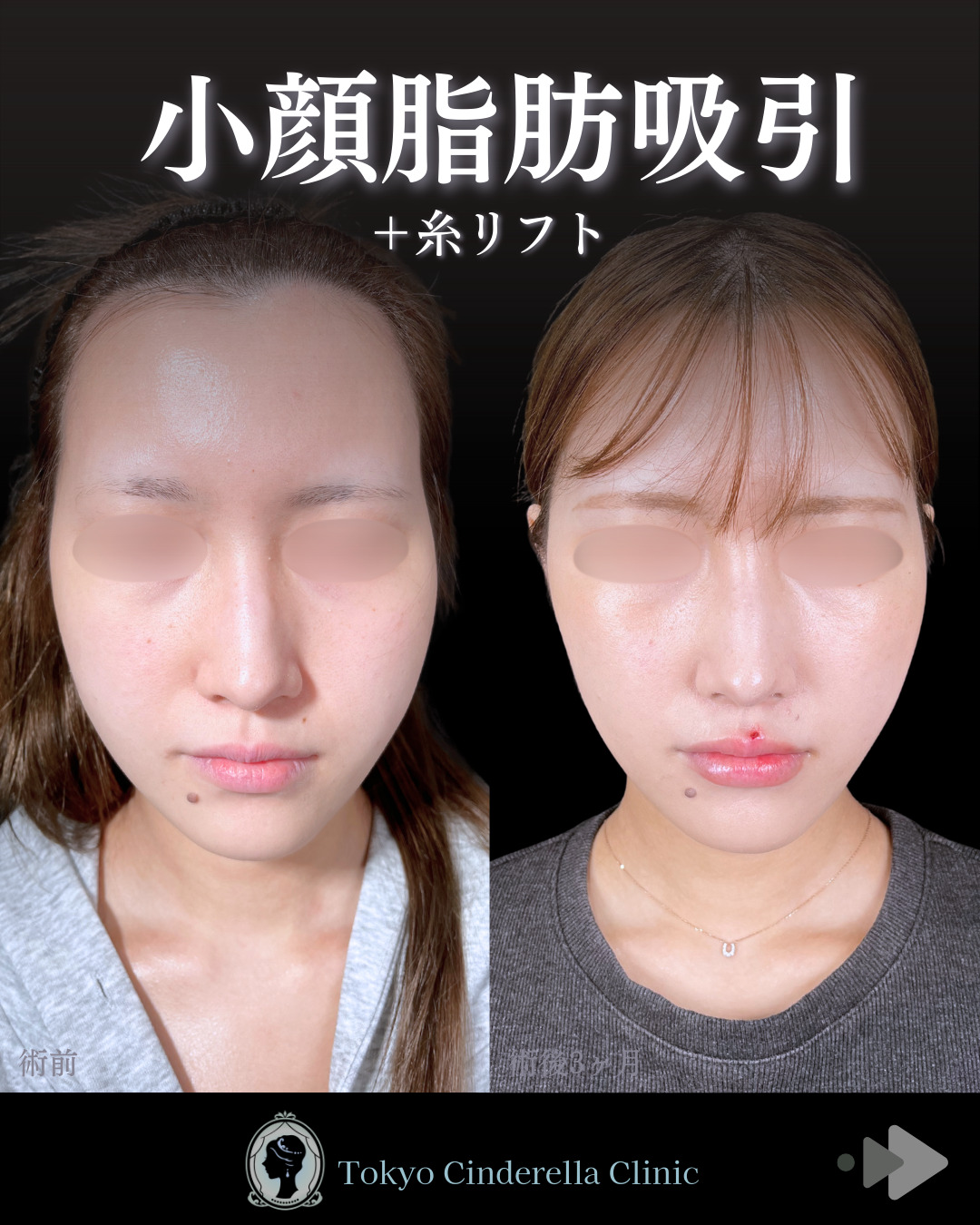 池袋院で行ったアキーセル小顔脂肪吸引(頬・あご下・エラ下・ジョールファット) と糸リフト６本と他院修正整形で有名な名医の石井達也の症例写真