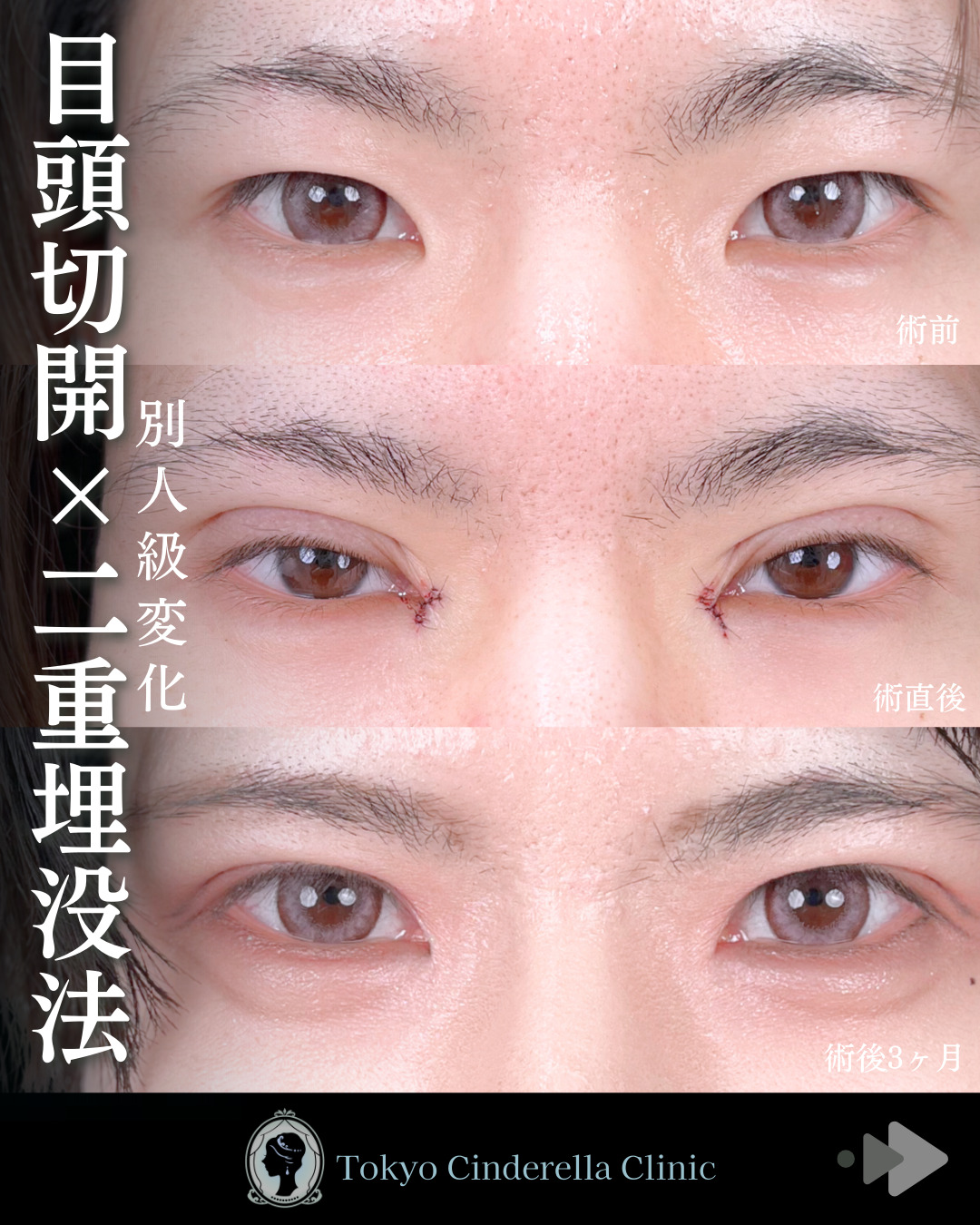池袋院で行った目頭切開と韓国式自然癒着法6点整形で有名な名医の石井達也の症例写真