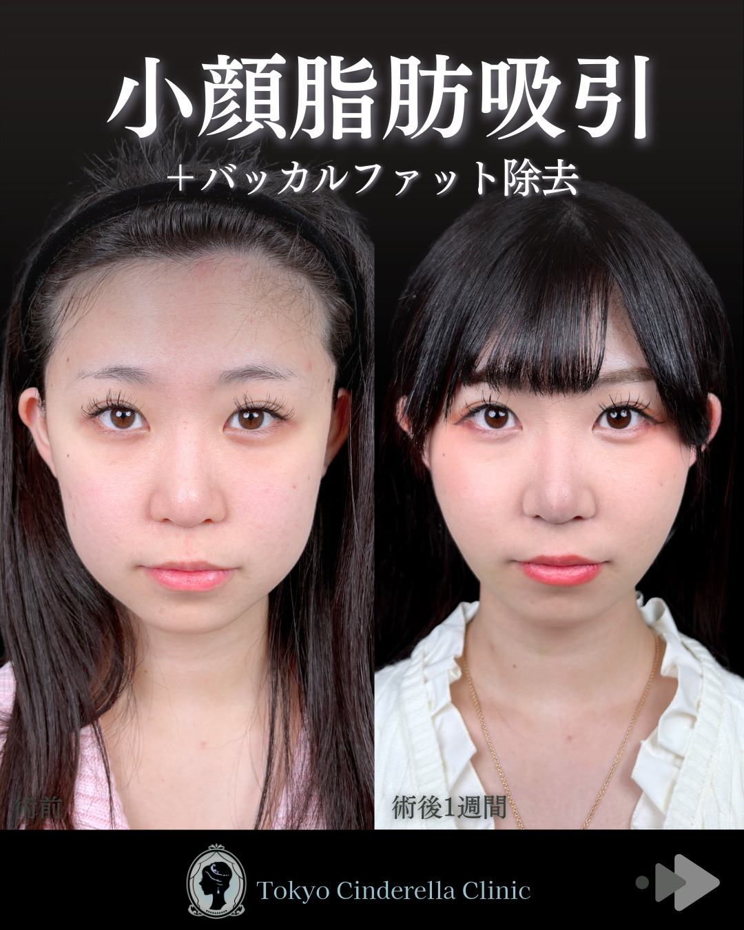 1週間後でこんなにスッキリ