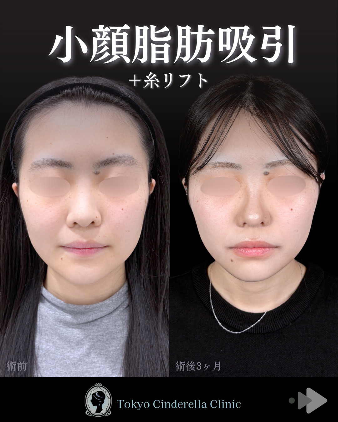 自然で美しいフェイスラインに 」に関する美容整形の症例写真の詳細
