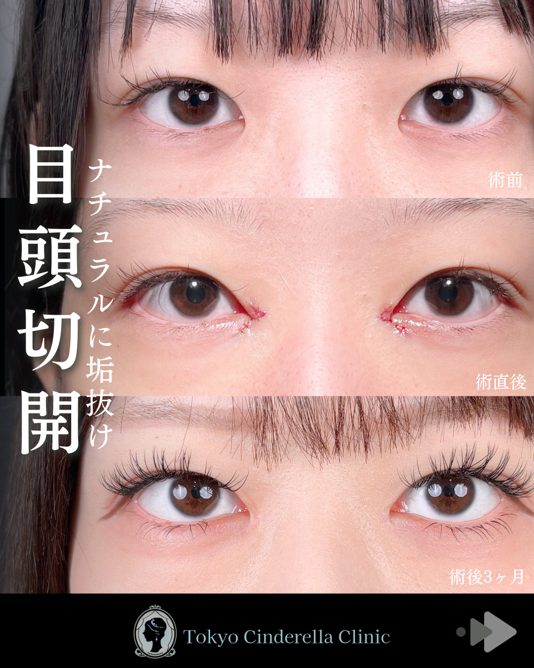 池袋院で行ったMD式目頭切開整形で有名な名医の石井達也の症例写真