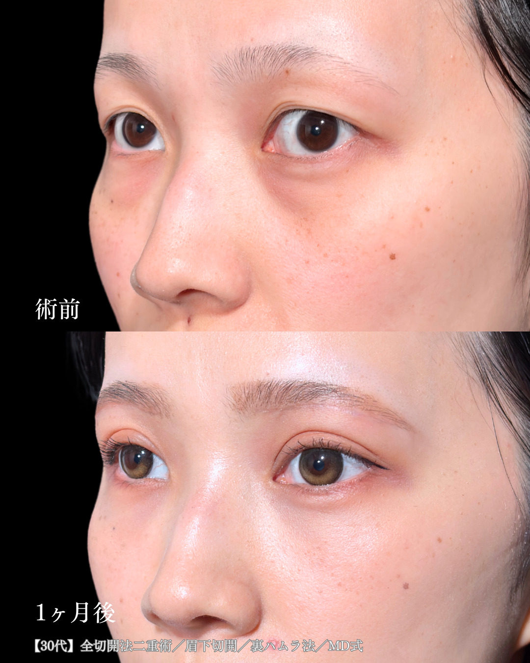 大宮院で行なった全切開二重術と眉下切開と裏ハムラ法の症例写真