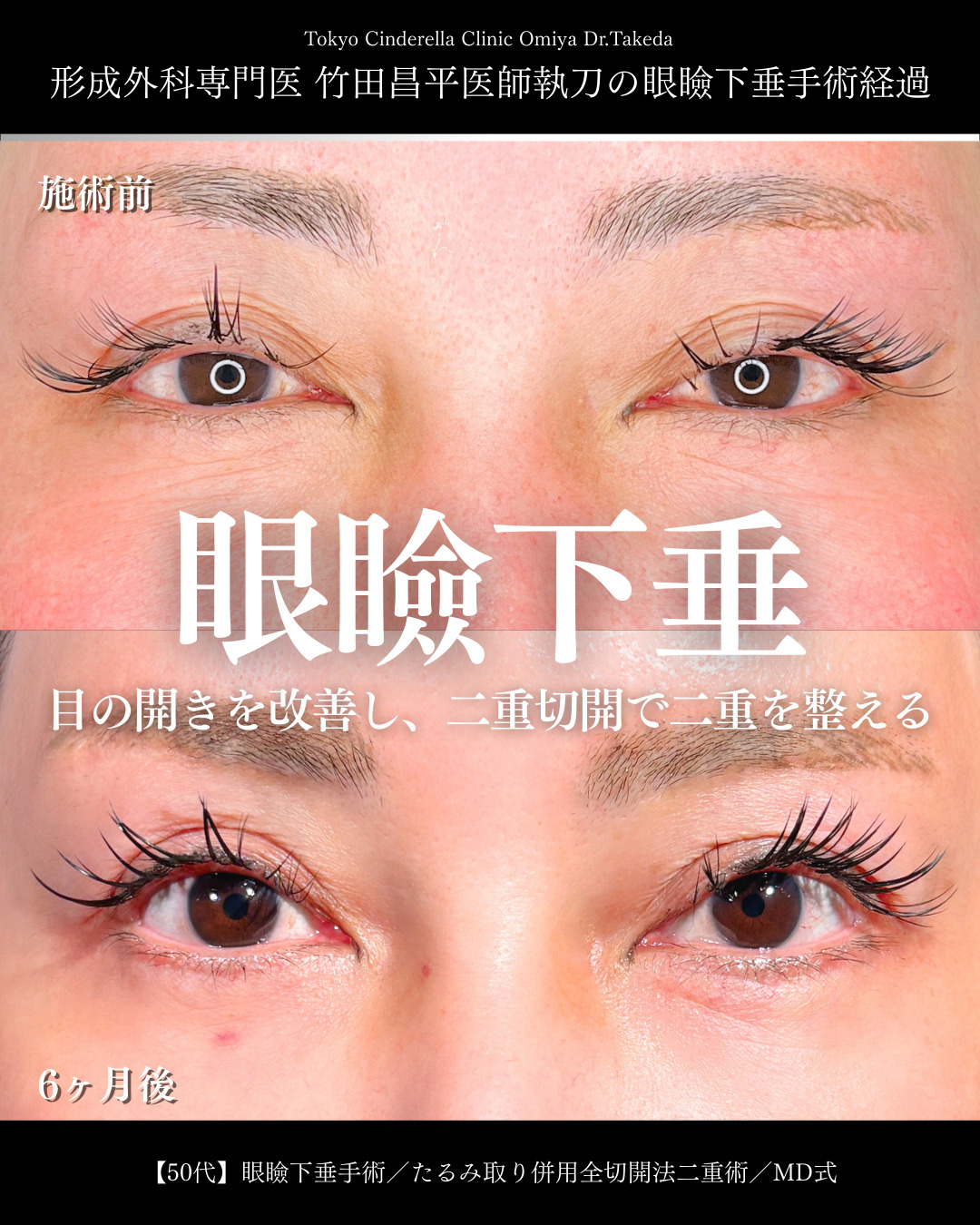 大宮院で行った二重整形で有名な竹田昌平医師のMD式のたるみ取り併用全切開法二重術と眼瞼下垂手術の6ヵ月後のダウンタイム症例写真