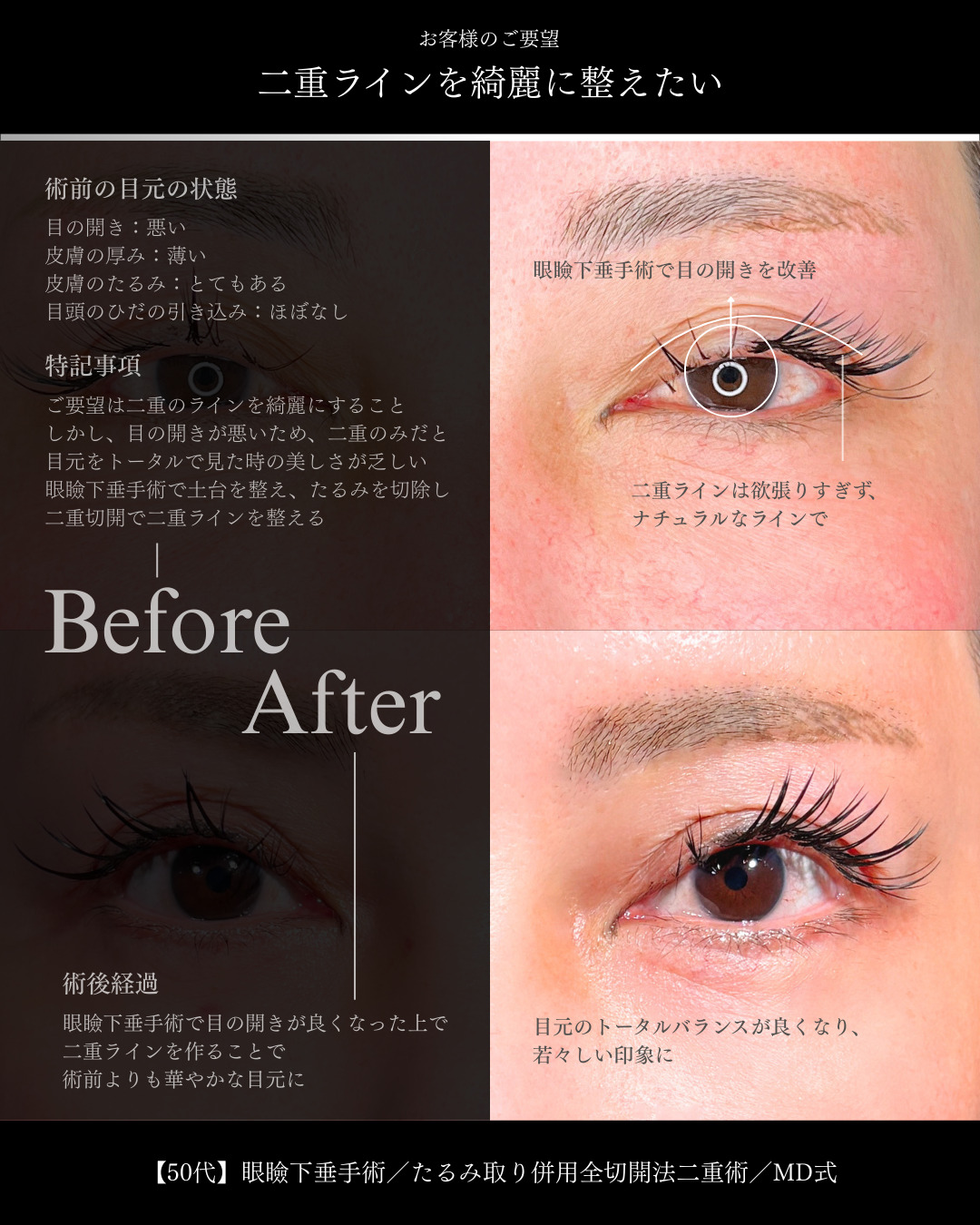 大宮院で行った二重整形で有名な竹田昌平医師のMD式のたるみ取り併用全切開法二重術と眼瞼下垂手術の6ヵ月後のダウンタイム症例写真