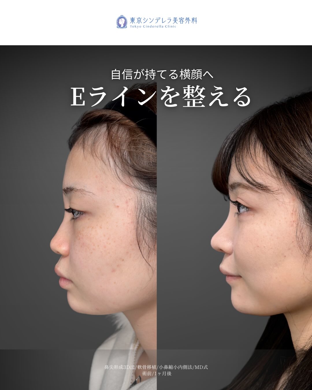 新宿院で行ったMD式の鼻尖形成3D法と軟骨移植と小鼻縮小内側法の1ヵ月後の症例写真