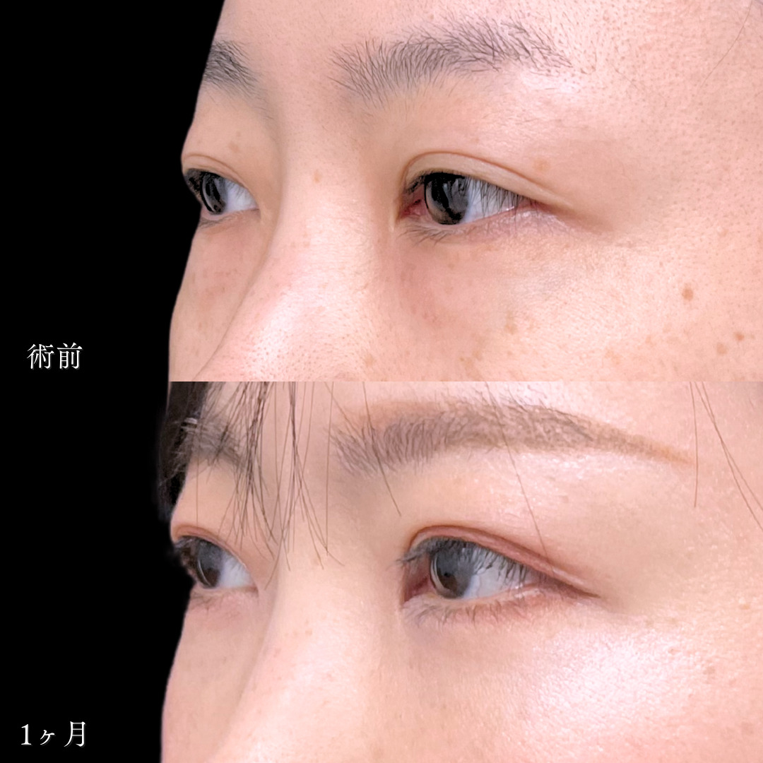 裏ハムラ法で目の下の膨らみが改善し若々しい目元になった40代の1ヶ月症例