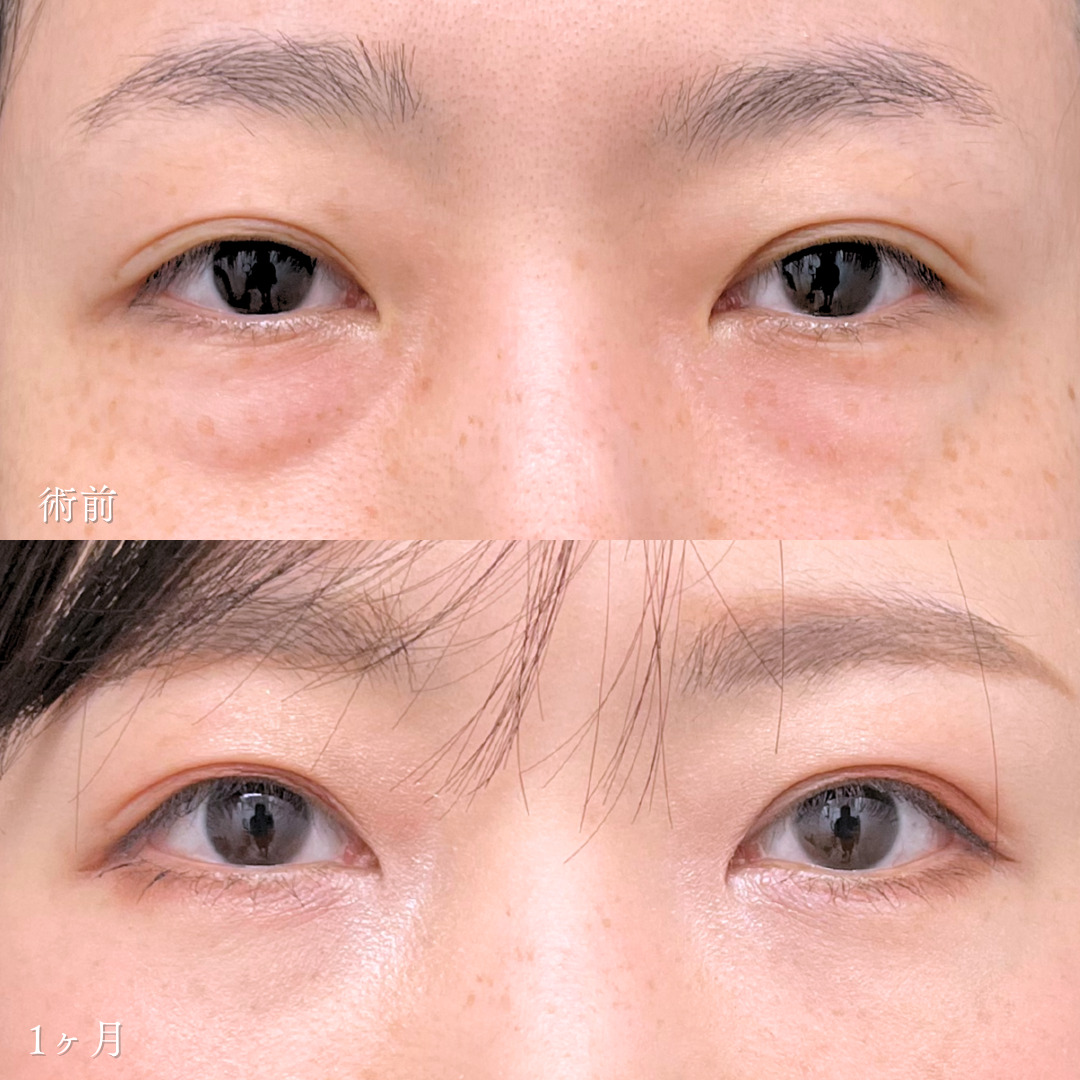 裏ハムラ法で目の下の膨らみが改善し若々しい目元になった40代の1ヶ月症例