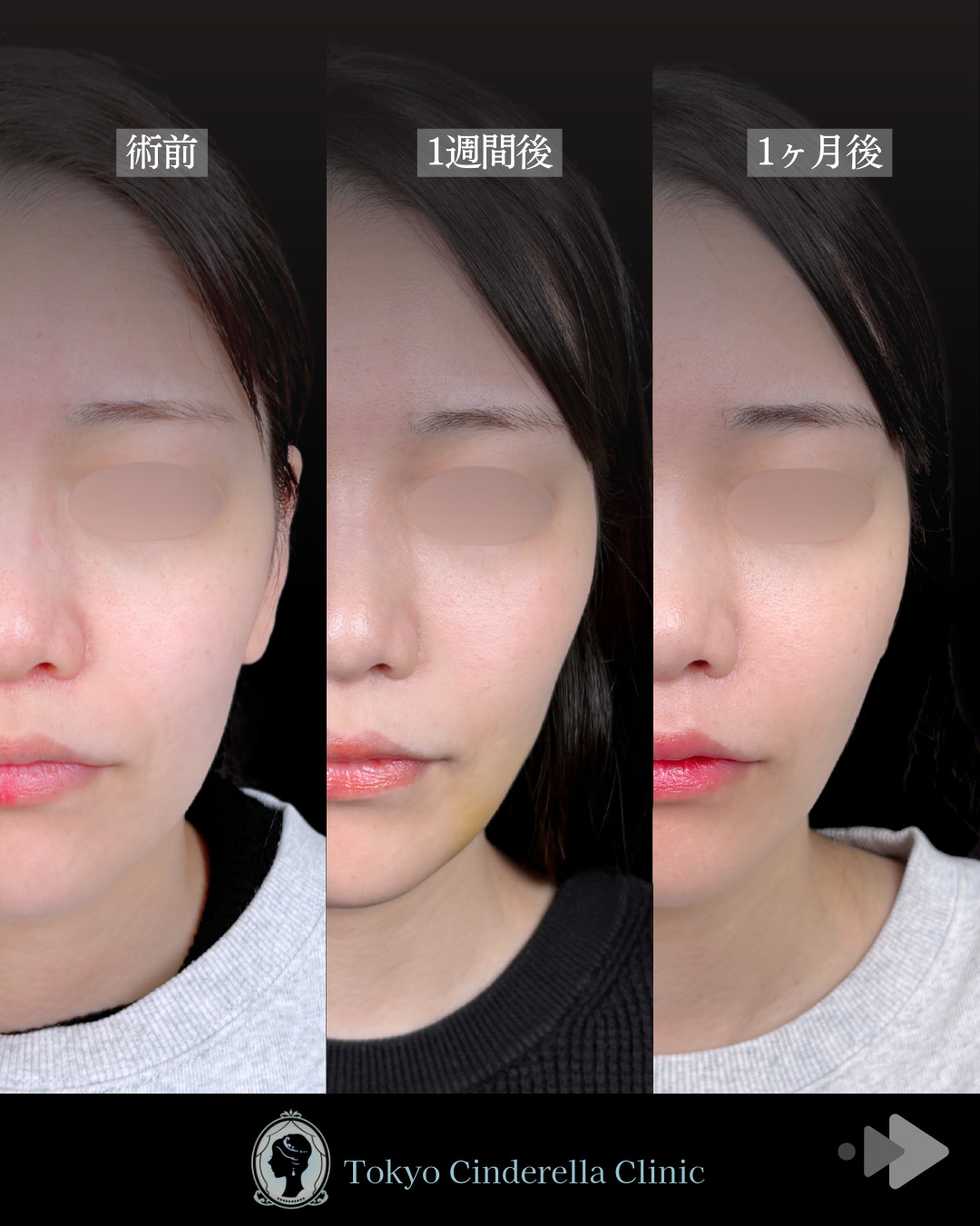 池袋院で行った小顔脂肪吸引(頬・あご下・エラ下・ジョールファット) とクイックリフト12本整形で有名な名医の石井達也の症例写真