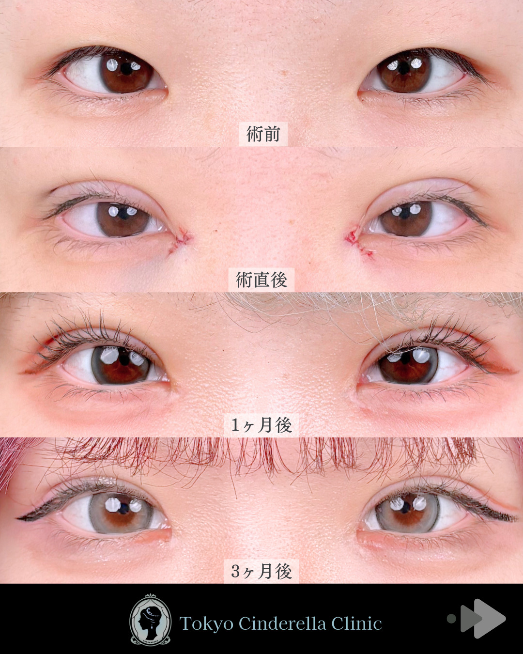 池袋院で行ったMD式目頭切開と韓国式自然癒着法6点整形で有名な名医の石井達也の症例写真