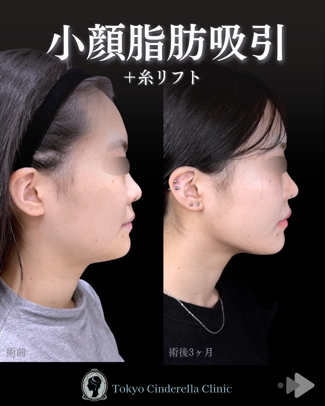 池袋院で行ったアキーセル小顔脂肪吸引(頬・あご下・エラ下・ジョールファット) とクイックリフト8本整形で有名な名医の石井達也の症例写真