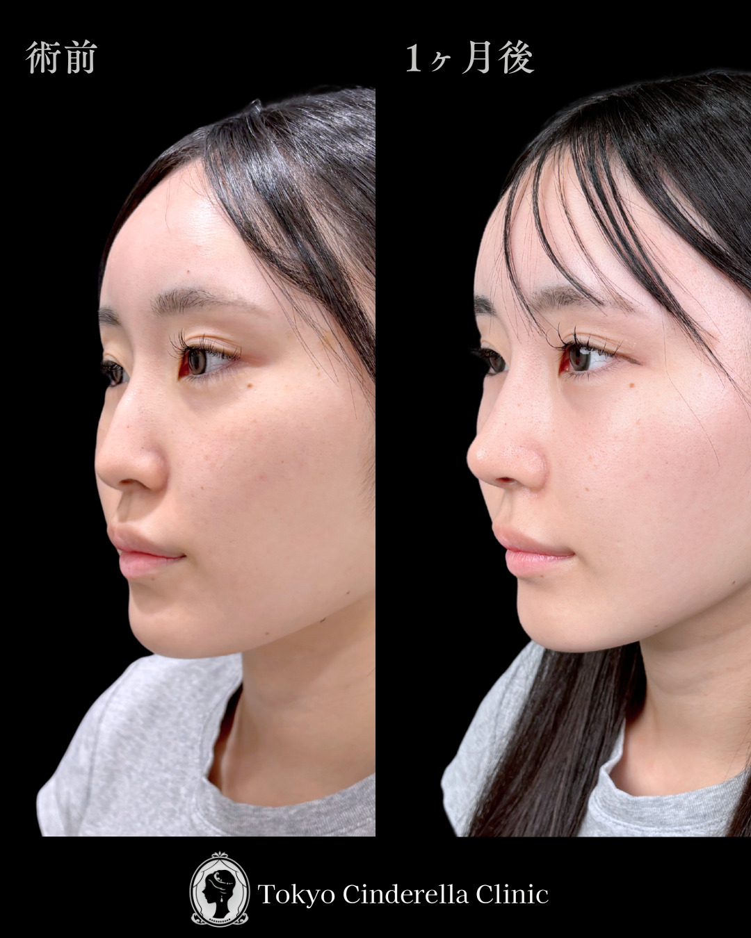 池袋院で行ったMD式の鼻尖形成3D法と軟骨移植とわし鼻削りとヒアルロン酸（貴族）整形の名医の症例写真