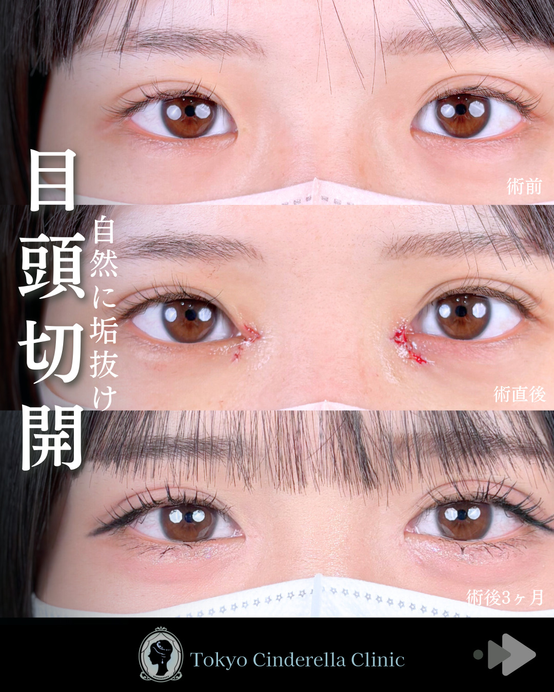 池袋院で行ったMD式目頭切開整形で有名な名医の石井達也の症例写真