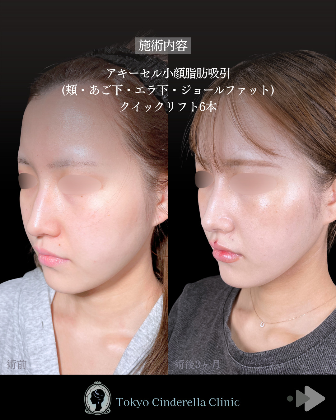 池袋院で行ったアキーセル小顔脂肪吸引(頬・あご下・エラ下・ジョールファット) と糸リフト６本と他院修正整形で有名な名医の石井達也の症例写真