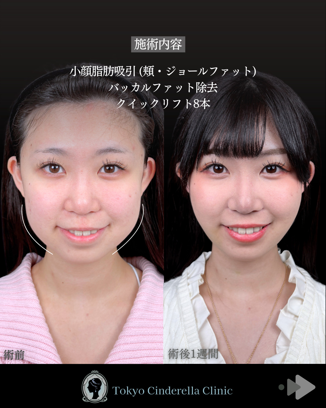 池袋院で行った小顔脂肪吸引(頬・ジョールファット)とバッカルファット除去とクイックリフト8本整形で有名な名医の石井達也の症例写真