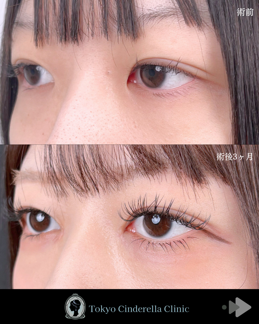 池袋院で行ったMD式目頭切開整形で有名な名医の石井達也の症例写真