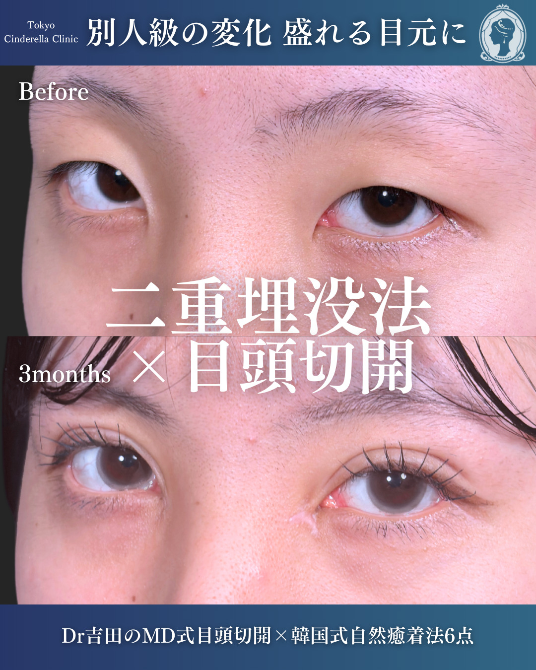 新宿院で行ったMD式目頭切開と韓国式自然癒着法6点整形で有名な名医の吉田利之の症例写真