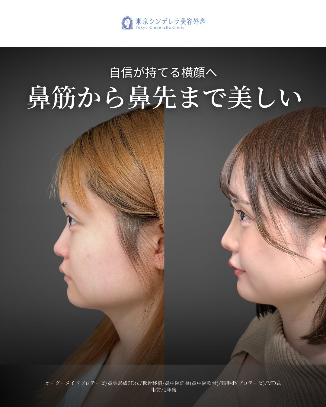 新宿院で行ったMD式の鼻尖形成3D法と軟骨移植とオーダーメイドプロテーゼと鼻中隔延長と猫手術の1年後の症例写真