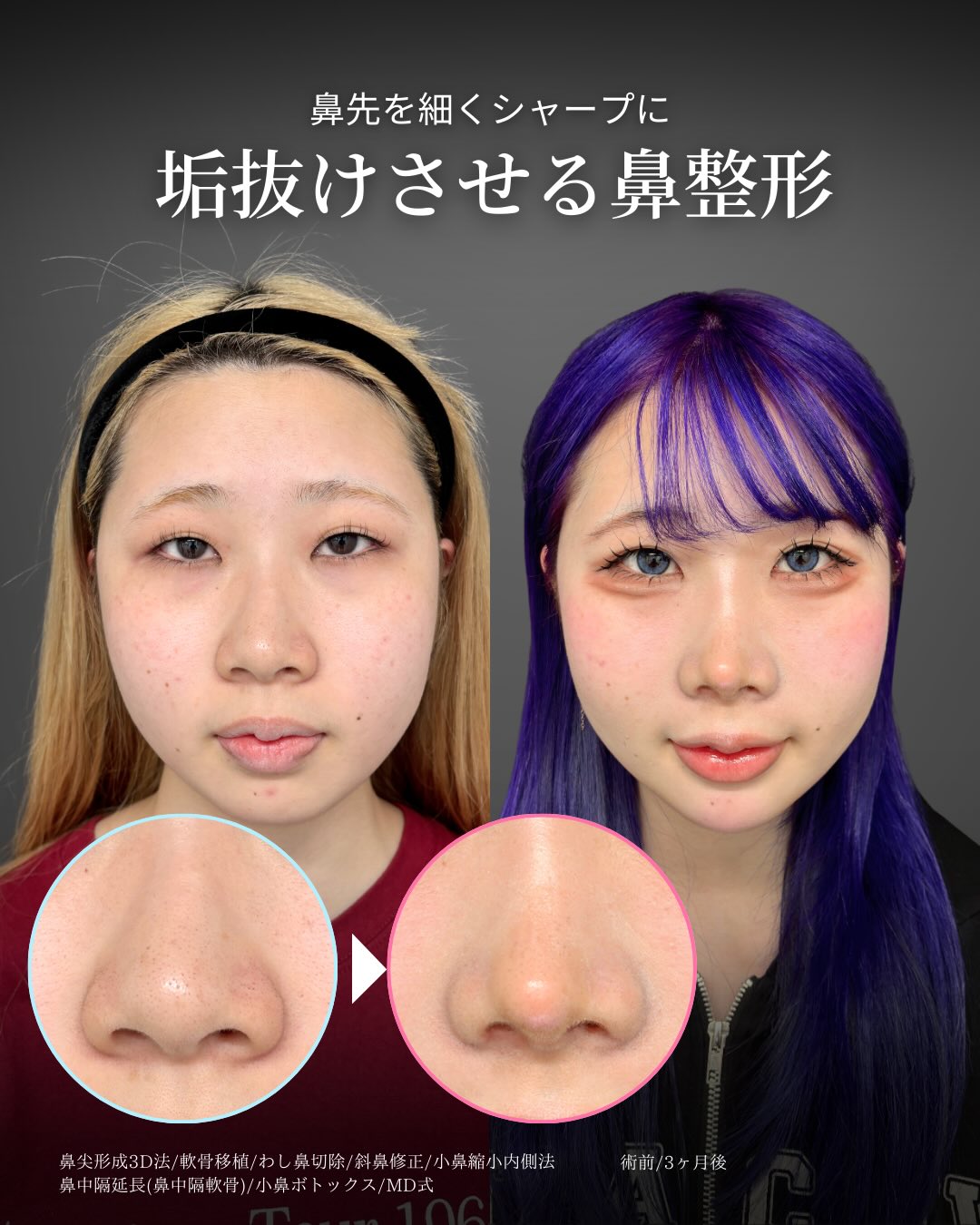 新宿院の鼻整形で有名な吉原伯医師のMD式の鼻尖形成3D法と軟骨移植と小鼻縮小内側法とわし鼻切除と斜鼻修正と小鼻ボトックスの鼻フル整形を行った3ヵ月後の症例写真