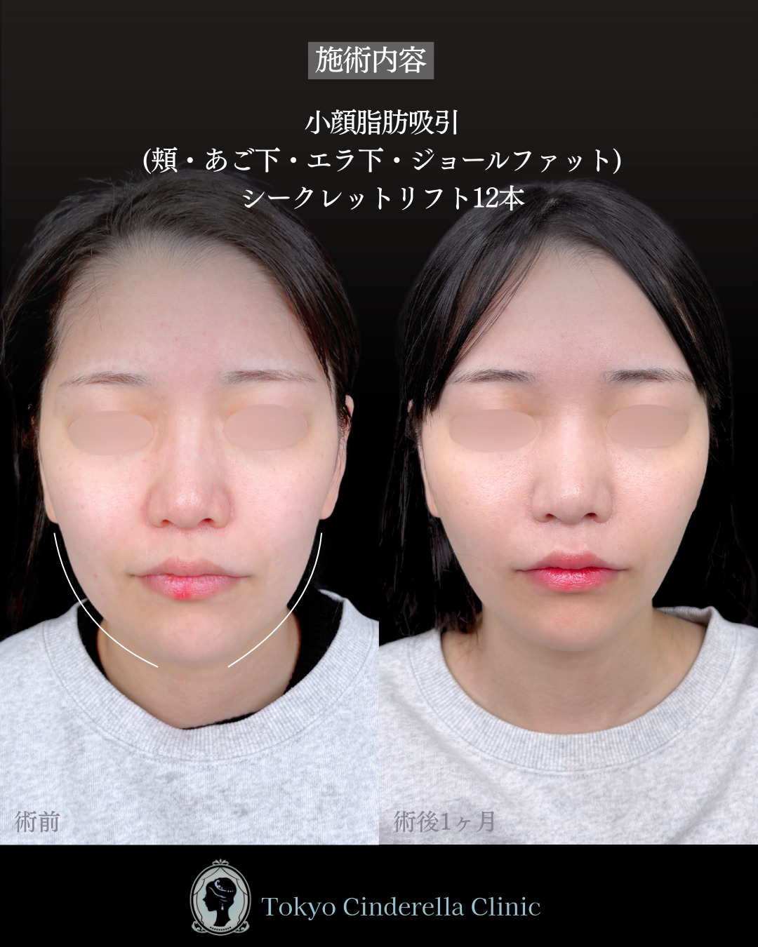 池袋院で行った小顔脂肪吸引(頬・あご下・エラ下・ジョールファット) とクイックリフト12本整形で有名な名医の石井達也の症例写真