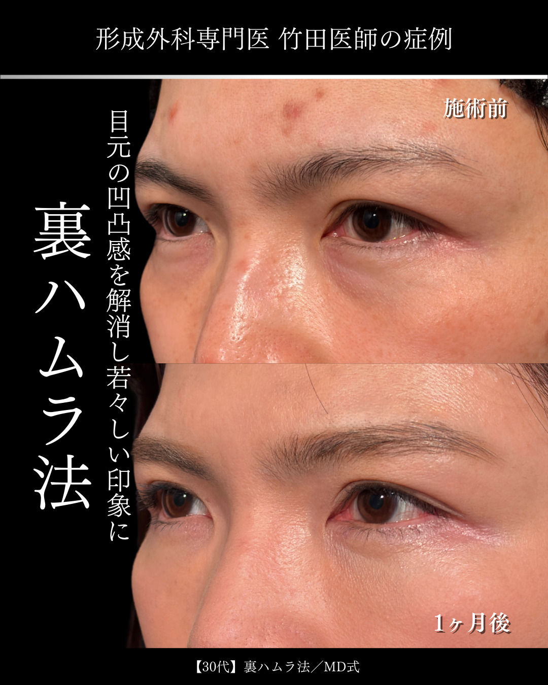 大宮院で行なった裏ハムラ法の1ヶ月の症例写真