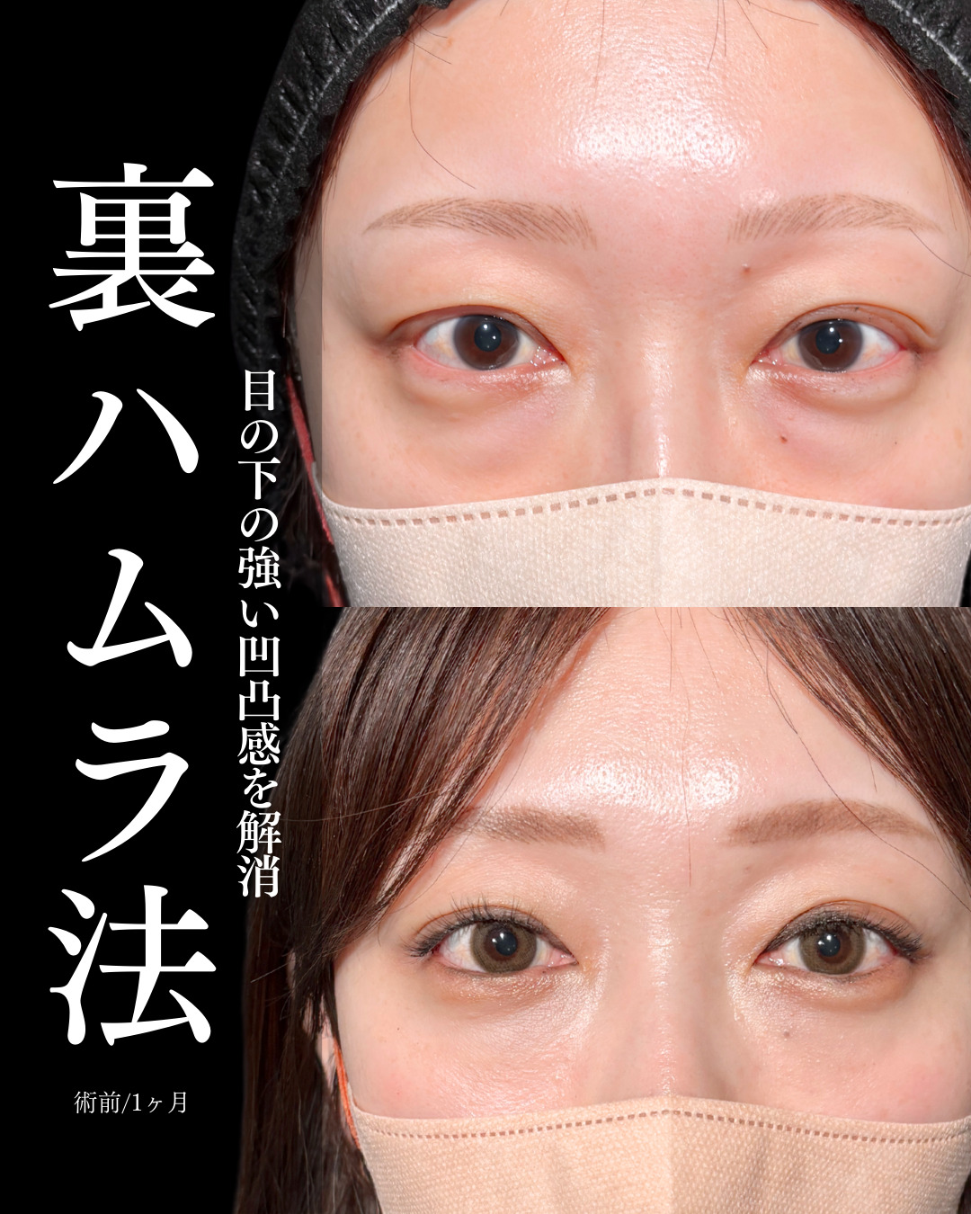 大宮院で行ったMD式の裏ハムラ法の1ヶ月後の症例写真