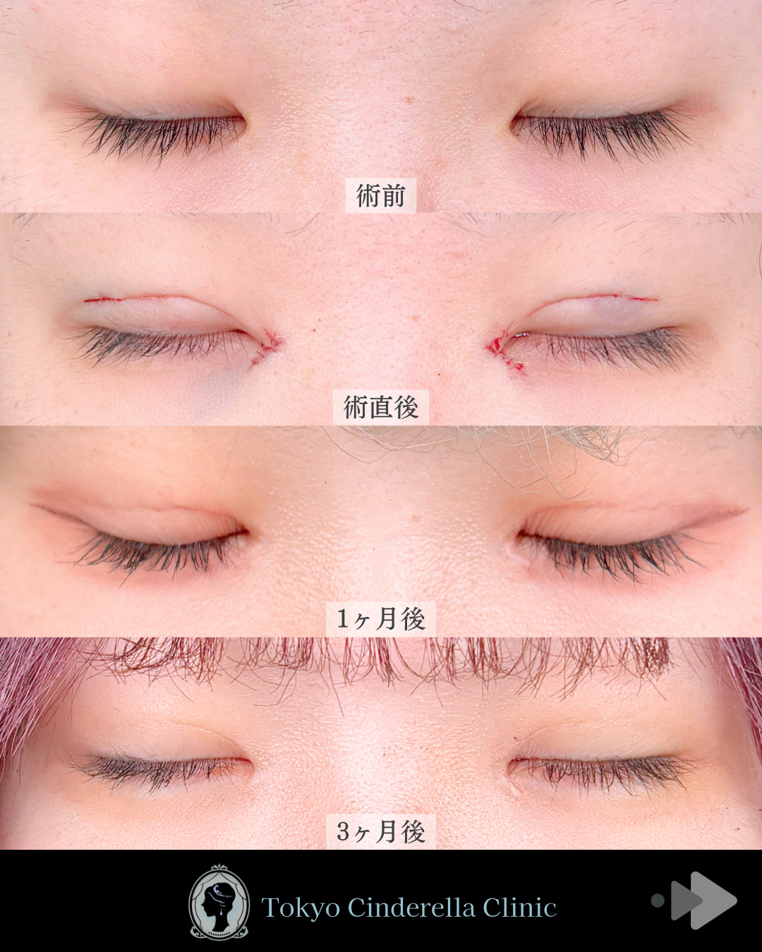 池袋院で行ったMD式目頭切開と韓国式自然癒着法6点整形で有名な名医の石井達也の症例写真