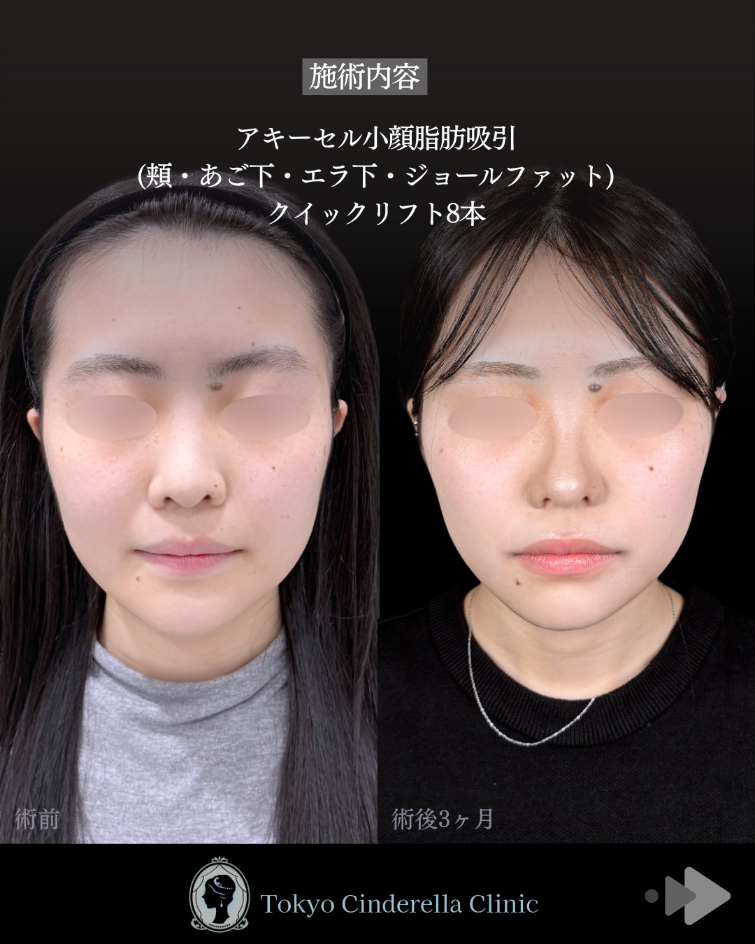 池袋院で行ったアキーセル小顔脂肪吸引(頬・あご下・エラ下・ジョールファット) とクイックリフト8本整形で有名な名医の石井達也の症例写真