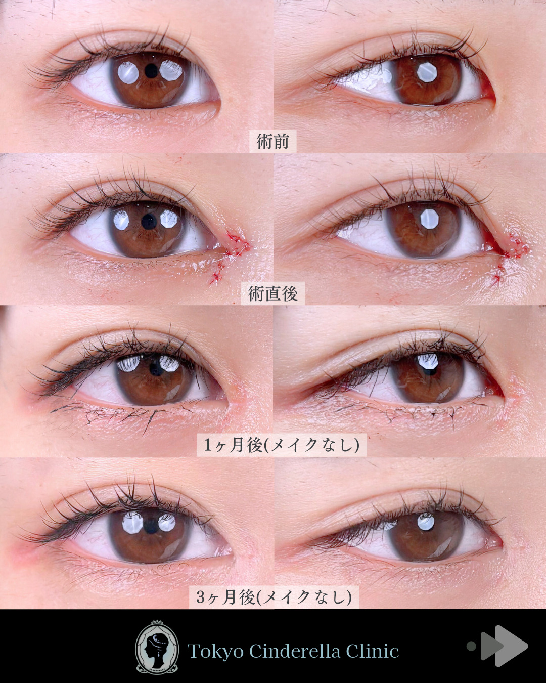 池袋院で行ったMD式目頭切開整形で有名な名医の石井達也の症例写真