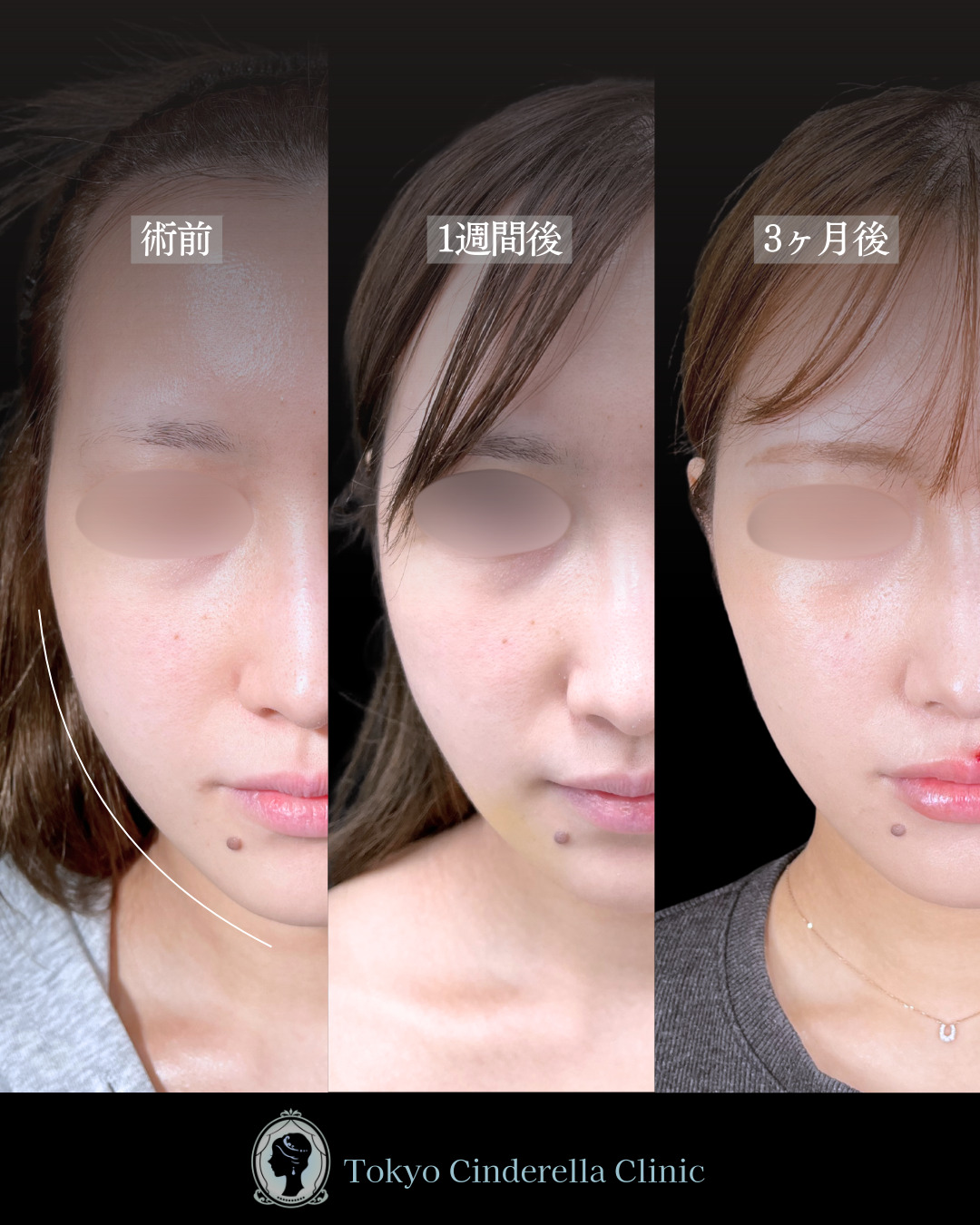 池袋院で行ったアキーセル小顔脂肪吸引(頬・あご下・エラ下・ジョールファット) と糸リフト６本と他院修正整形で有名な名医の石井達也の症例写真