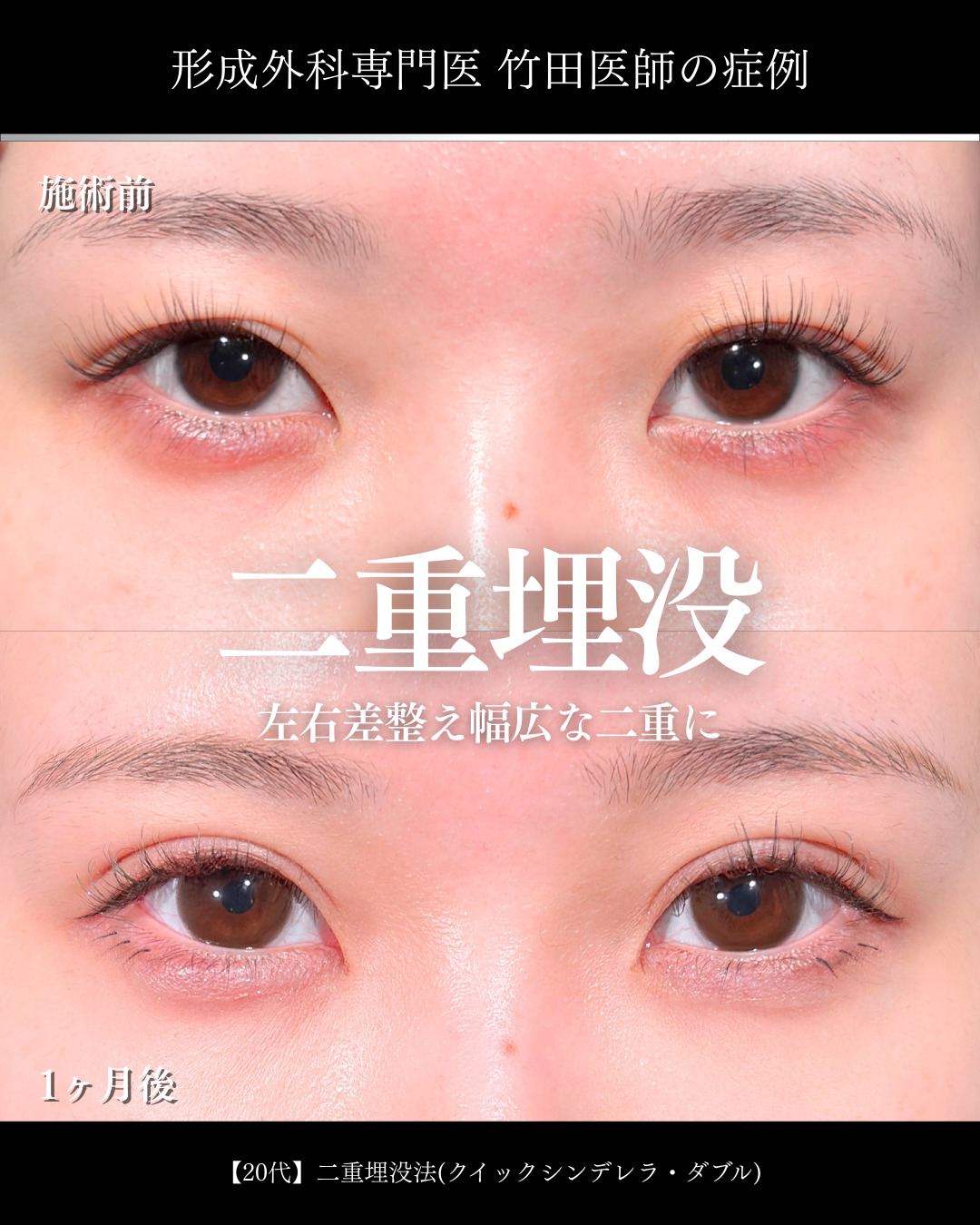 大宮院で行った二重埋没法の1ヶ月後の症例写真