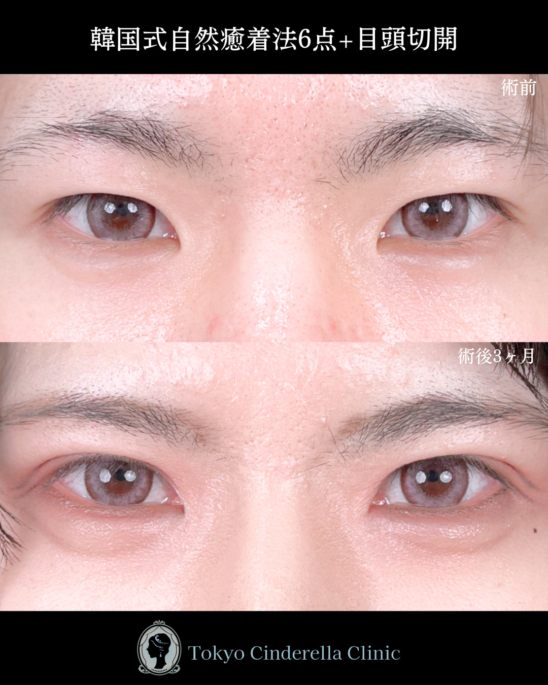 池袋院で行った目頭切開と韓国式自然癒着法6点整形で有名な名医の石井達也の症例写真