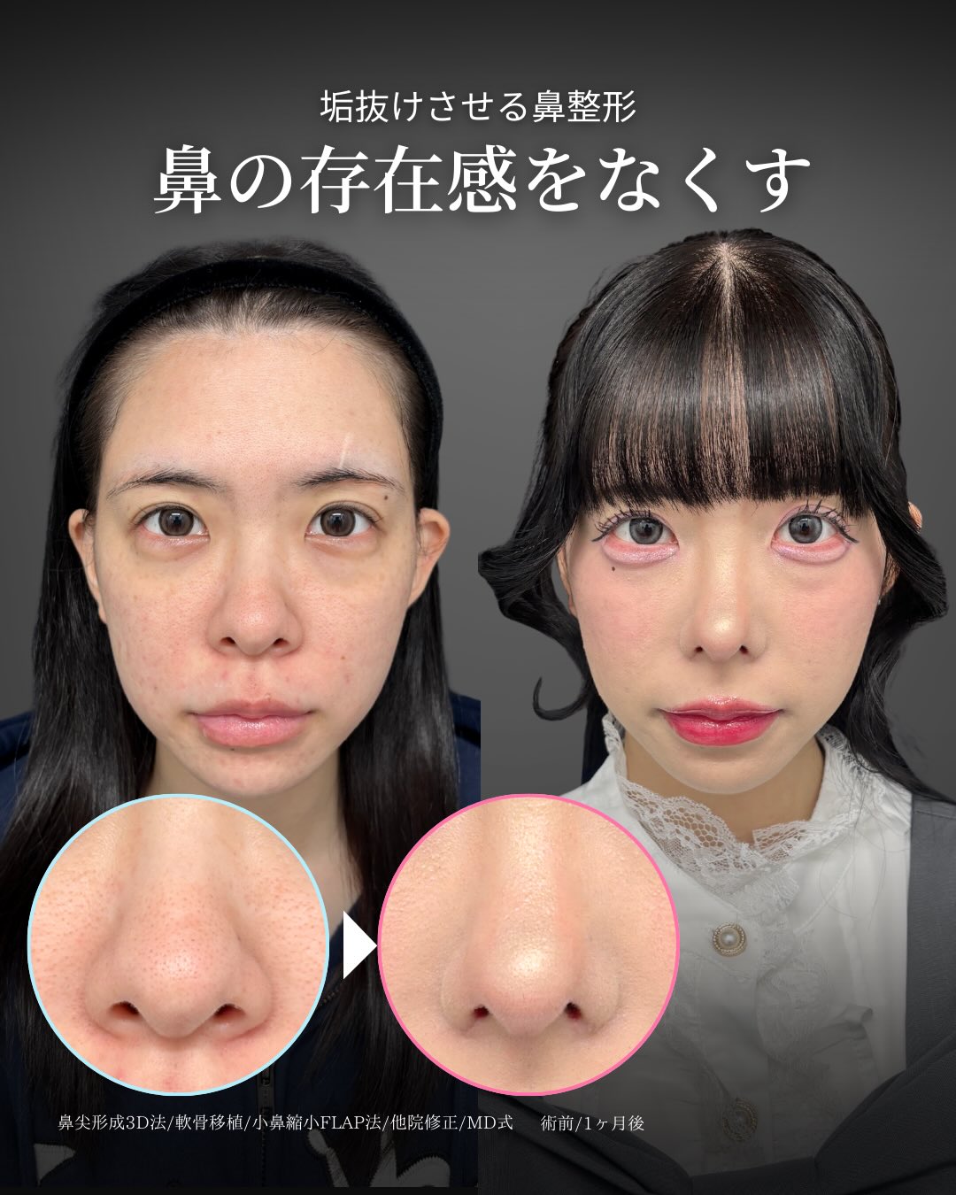 鼻の存在感を無くし垢抜け 」に関する美容整形の症例写真の詳細 | 新宿