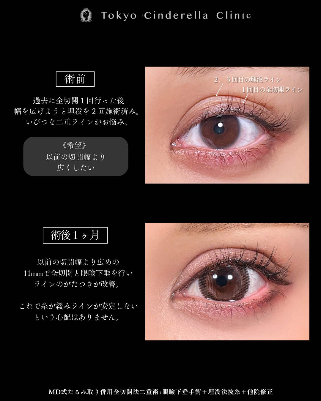 新宿院で行った二重整形で有名な吉原伯医師のMD式のたるみ取り併用全切開法二重術と眼瞼下垂手術と他院修正の1ヵ月後のダウンタイム症例写真